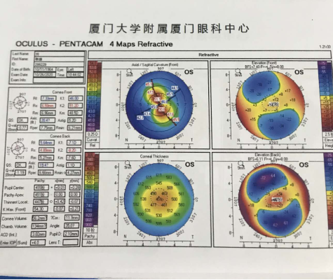 白內障手術